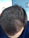 hattingen hair transplant-Dr muresanu 5 momths post op2.jpg