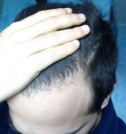 hattingen hair transplant-Dr muresanu 5 momths post op3.jpg
