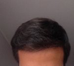 hattingen hair transplant-Dr muresanu 13 momths post op1.jpg
