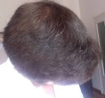 hattingen hair transplant-Dr muresanu 13 momths post op3.jpg