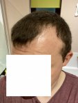 front LH hairline 28 JUN 20.jpg