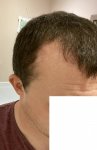 front RH hairline 28 JUN 20.jpg