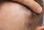 Before hair transplant3.jpg