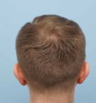 Hair transplant donor area.jpg