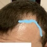 Temple points and hairline.jpg