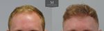 ID1257_Before_After_Front.jpg