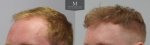 ID1257_Before_After_left_45.jpg