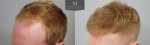 ID1257_Before_After_left-Hairline.jpg