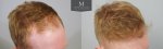 ID1257_Before_After_right_Hairline.jpg
