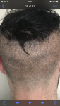 2nd day post FUE hair transplant..png