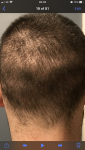 1 month post hair transplant shockloss.png