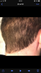 3 months post hair transplant.png