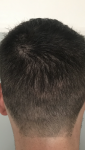 6 months post op hair transplant.png