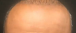 Michael Greco Hairline.png