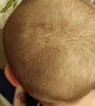 finasteride regrowth.jpg