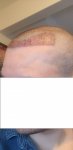 Day 2 Post Op 5 edit.jpg