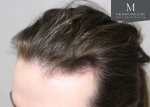 The Maitland Clinic Review1_Before_left-45_hairline (1).jpg