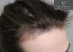 The Maitland Clinic Review3_Before_right-45_hairline.jpg