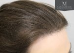 The Maitland Clinic Review4_After_right-45_hairline.jpg