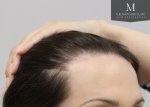 The Maitland Clinic Review6_FUT_before_After-right45.jpg