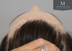 The Maitland Clinic Review24_After_behind_above_hairline.jpg