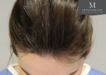 The Maitland Clinic Review25_Before_Front_tilt_hairline-closeup.jpg