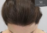 The Maitland Clinic Review26_After_Front_tilt_hairline-closeup.jpg