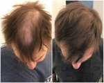 Frederik after 10 months PRP.jpg