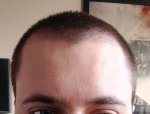 Day 31 Post Op 4.jpg