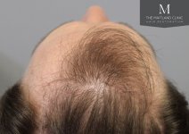 The Maitland Clinic - Before_hairline.jpg