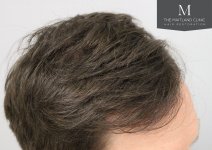 The Maitland Clinic - After_right_hairline.jpg