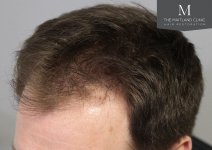 The Maitland Clinic - Before_left_hairline.jpg