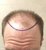 before_with proposed hair line.jpg