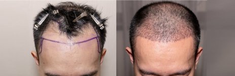 best-hair-transplant-clinic.jpg