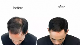 Hair Growth Before After.png