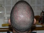 2 days after beard hairs in recipient area.jpg