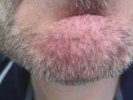 1 week donor beard.jpg