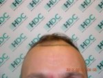 Feb 1st Before Procedure.JPG