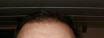 4 Month Gel hairline.JPG