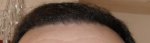 Hair line 5months.JPG