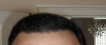 Front Hairline  6MONTH.JPG