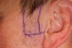 Sideburn-tranplant-before.gif.jpg