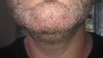 3rd procedure 3rd day resized.jpg