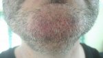 3rd procedure 3rd day 2 resized.jpg