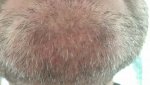 beard donor day 6 resized.jpg