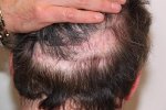 11 months rear donor with right side scar after acell pre bhr.JPG