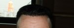 Front Hairline  8 month .JPG