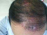 Folliculitis after hair transplantation.jpg
