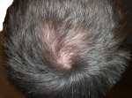 Tonsure_Day157_with_flash.jpg