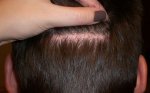 scar_backside_day157_post_op.jpg